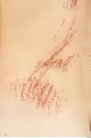 human skin scar 0007